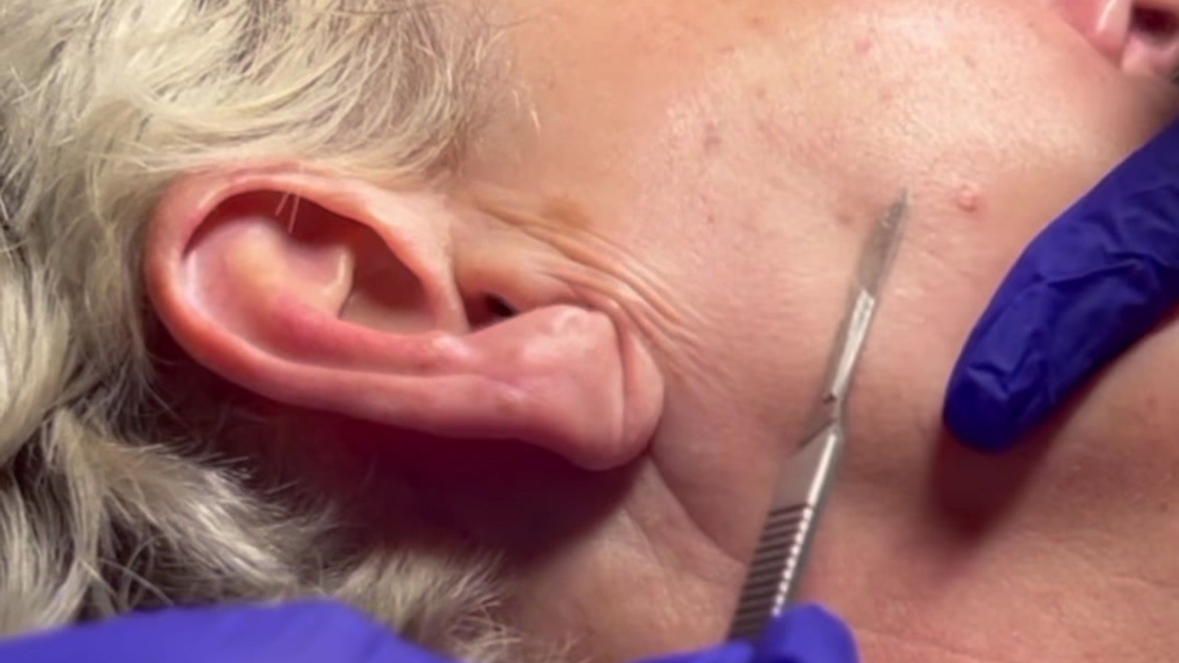 Dermaplane